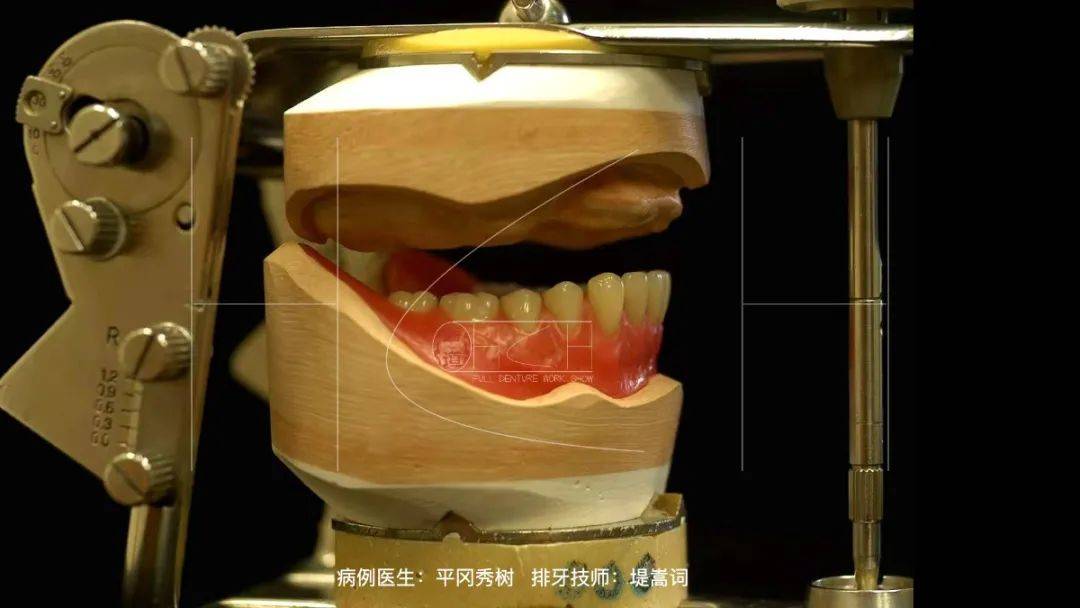义齿加工所_义齿加工是什么工作_义齿加工中心